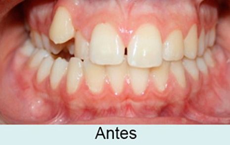 Clínica Dental García Agúndez ortodoncia antes 2