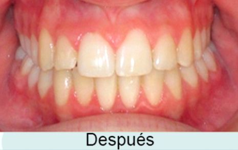 Clínica Dental García Agúndez ortodoncia después 2