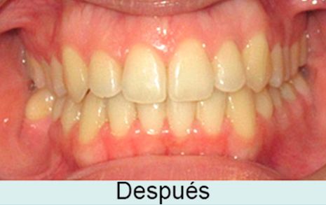 Clínica Dental García Agúndez ortodoncia después 