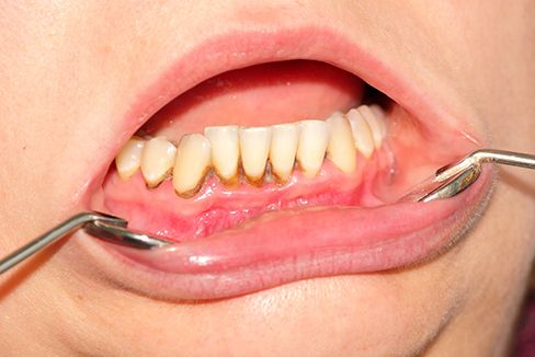 Clínica Dental García Agúndez periodoncia