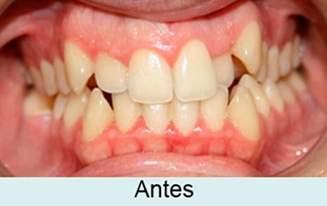 Clínica Dental García Agúndez ortodoncia antes